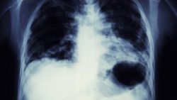 Cancerous Lung X-Ray